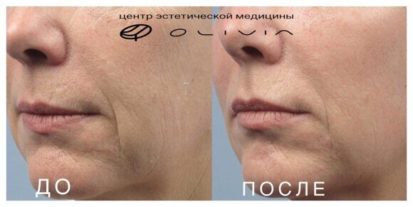 Лазерная шлифовка лица